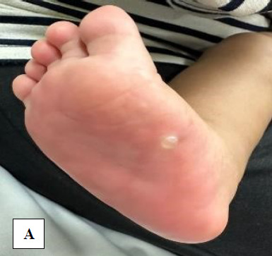 Unforeseen sequela of a traditional remedy: A garlic burn case report.