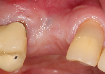 <i>Barbell Technique</i> Associated With <i>Sinus Lift</i> for Horizontal and Vertical Guided Bone Regeneration-Case Report.