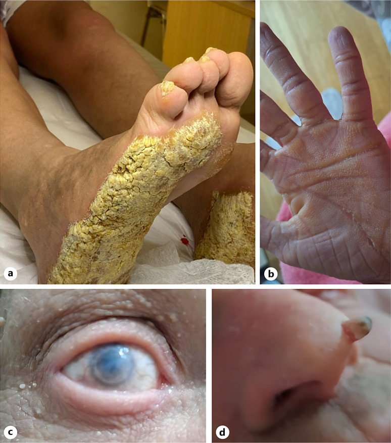 Keratitis, Ichthyosis, and Deafness Syndrome with Endocarditis and Myelitis: A Rare Case Report.