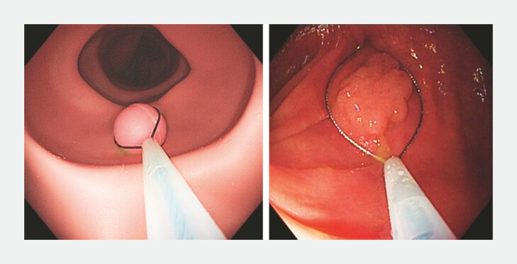 Use of artificial intelligence to measure colorectal polyp size without a reference object.