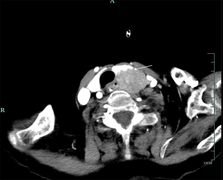 Potential higher malignancy of nonfunctional parathyroid carcinoma: a case series study.