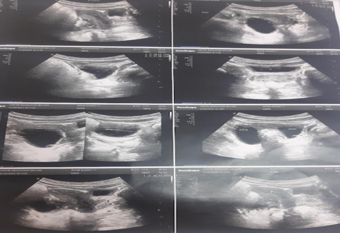 [Precocious puberty in the McCune-Albright Syndrome: a case report].