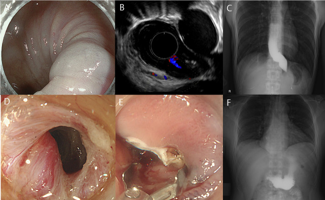 Peroral endoscopic myotomy for achalasia combined with esophageal varices.