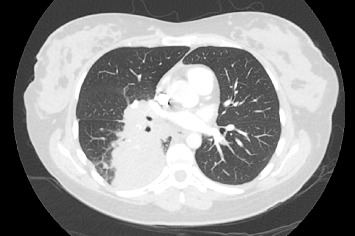 Beating the Odds: A Successful Pregnancy in a Patient With ALK-Rearranged Lung Cancer on Alectinib.