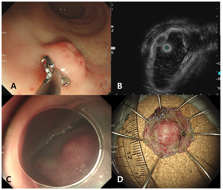 A 12 mm-sized rectal subepithelial tumor: uncommon, but one you must know.