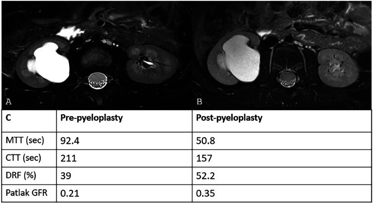 Magnetic Resonance Urogram in Pediatric Urology: a Comprehensive Review of Applications and Advances.