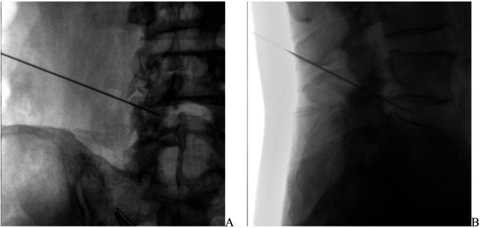 The predictive value of neutrophil-to-lymphocyte ratio in the efficacy of percutaneous lumbar disc radiofrequency ablation for lumbar disc herniation.