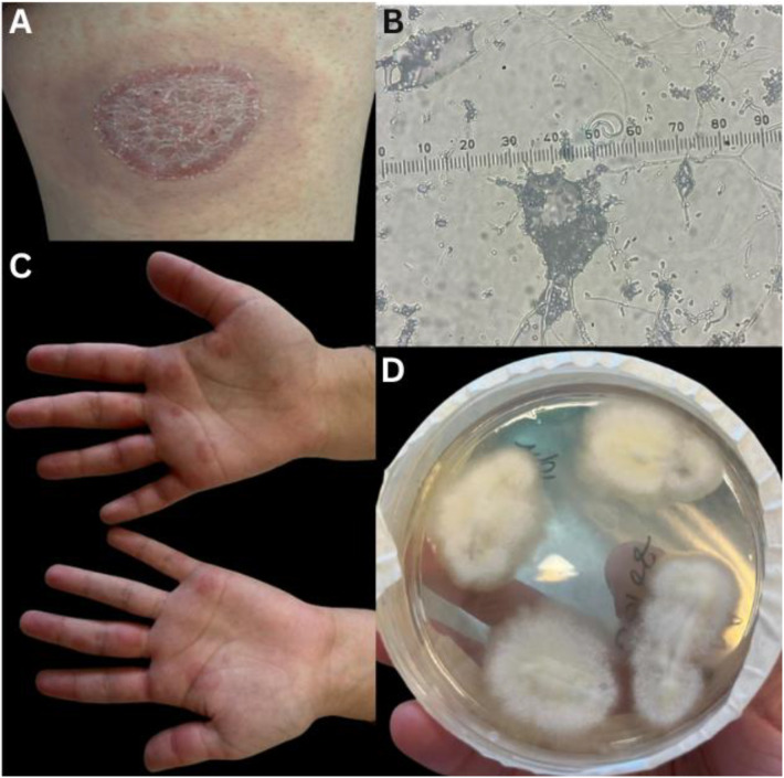 Erythema Multiforme Triggered by <i>Trichophyton mentagrophytes: An unusual association</i>.