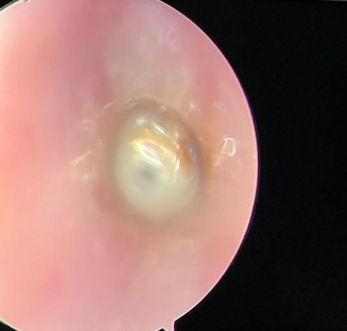 [Impacted subglottic fish vertebra in an infant: an unusual case report].