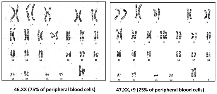 A case of trisomy 9 with mixed-field ABO blood type.