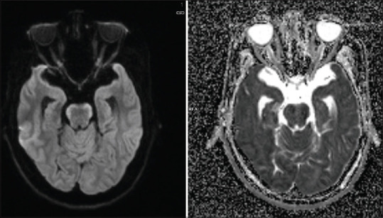 "Bloomy Rind on Cheese Sign" - A Radiological Biomarker of Leptomeningeal Metastasis.