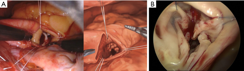 Outcomes of robotic and endoscopic combined aortic and mitral valve surgery: experience from National Taiwan University Hospital.