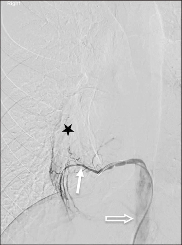 A Case of an Uncommon Cause of Pulmonary Abscess: Intralobar Bronchopulmonary Sequestration.