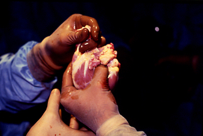 Cardiac Transplantation: The Second Epoch of a Sacred Adventure.