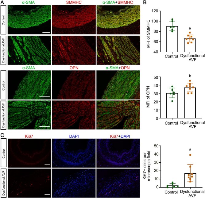Mineralocorticoid receptor antagonism attenuates arteriovenous fistula stenosis by modulating the phenotype of vascular smooth muscle cells.