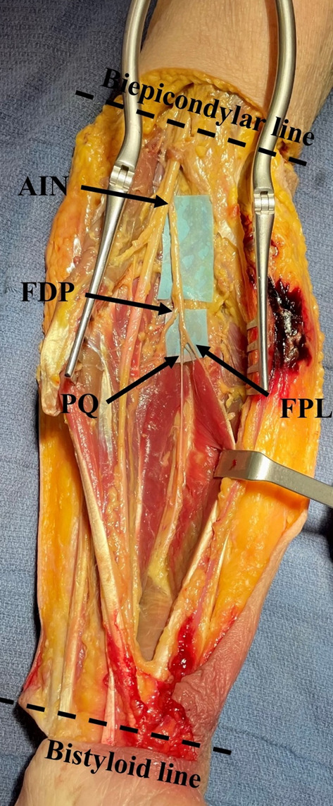 Risk of anterior interosseous nerve injury during forearm surgery: a cadaveric study.