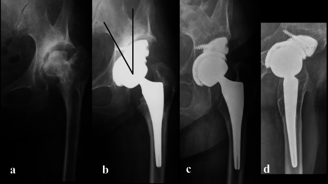 The use of porous titanium acetabular augments in primary total hip arthroplasty for hip dysplasia or rapidly destructive coxopathy.