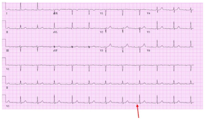 Case With Refractory Myasthenia Gravis Caused by Pembrolizumab.