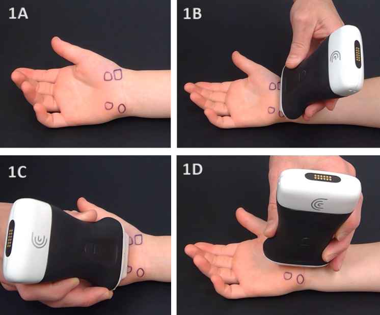 Diagnostic Musculoskeletal Ultrasound in the Evaluation of the Median Nerve.