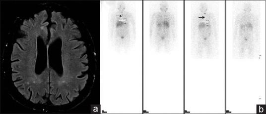 The Usefulness of 131 I-MIBG Myocardial Scintigraphy in a Case of Pure Autonomic Failure - First Report in the Literature.