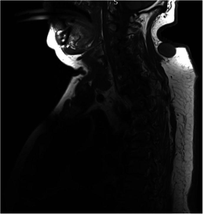 Charcot spinal arthropathy: a case series.