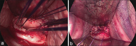 Comparative Long-term Outcomes of Laparoscopic Radical Hysterectomy with Sentinel Node Navigation and Open Surgery for Cervical Cancer.
