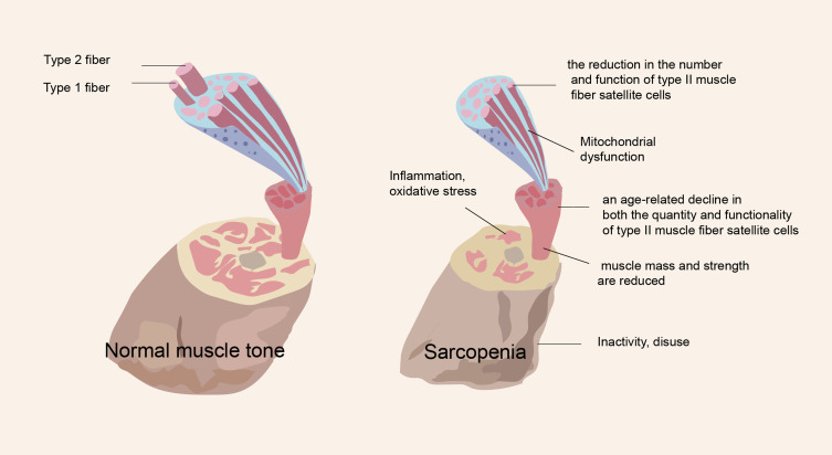 Exploration of Pathogenesis and Cutting-Edge Treatment Strategies of Sarcopenia: A Narrative Review.
