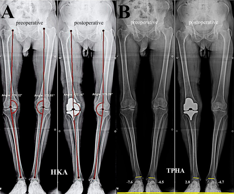 Assessment and quantification of ipsilateral and contralateral ankle joint alignment changes after unilateral total knee arthroplasty for knee osteoarthritis with varus deformity: a retrospective cohort study.