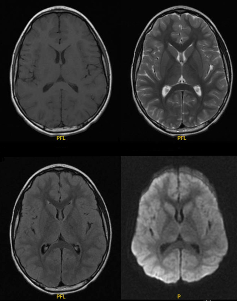 Chronic Inflammatory Demyelinating Polyneuropathy Following Natural Influenza A Infection in a Pediatric Patient: A Case Report and Literature Review.