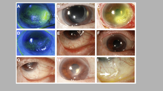 Subconjunctival dexamethasone implant (Ozurdex<sup>®</sup>) in the management of refractory Non-Infectious anterior scleritis.