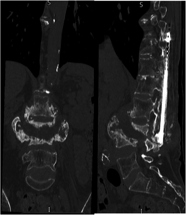 Charcot spinal arthropathy: a case series.