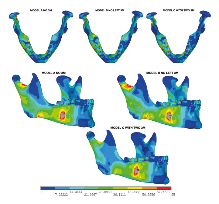 The interaction between third molars and surrounding periapical tissues in mandibular stress distribution during high-impact trauma: a finite element study.