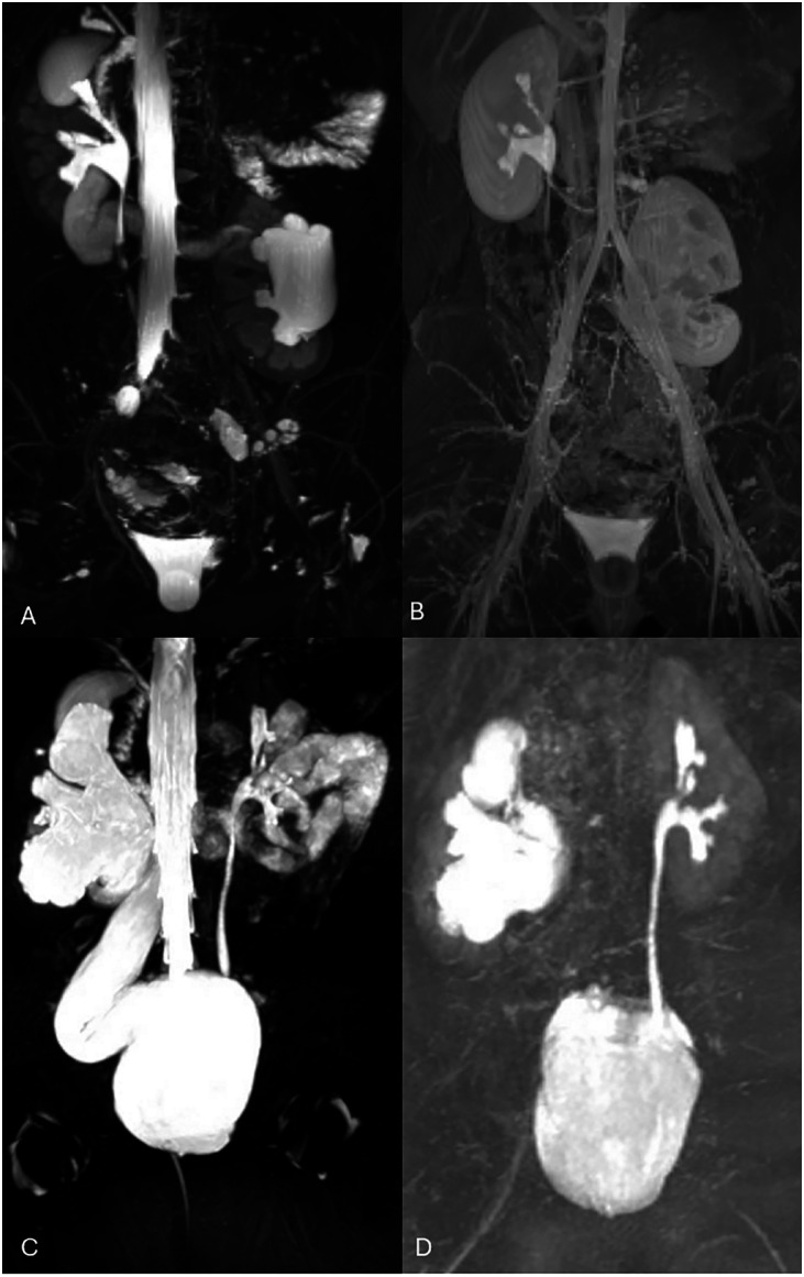 Magnetic Resonance Urogram in Pediatric Urology: a Comprehensive Review of Applications and Advances.