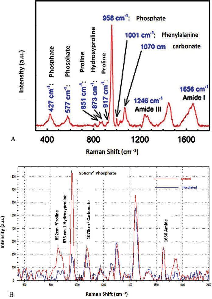 Biofilm-Induced Bone Degradation in Osteomyelitis: <i>Insights from a comprehensive ex vivo pathogen interaction study</i>.
