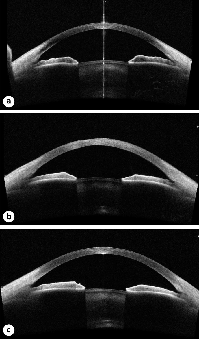Fungal Keratitis following the Application of Green Tea Bag Warm Compresses.