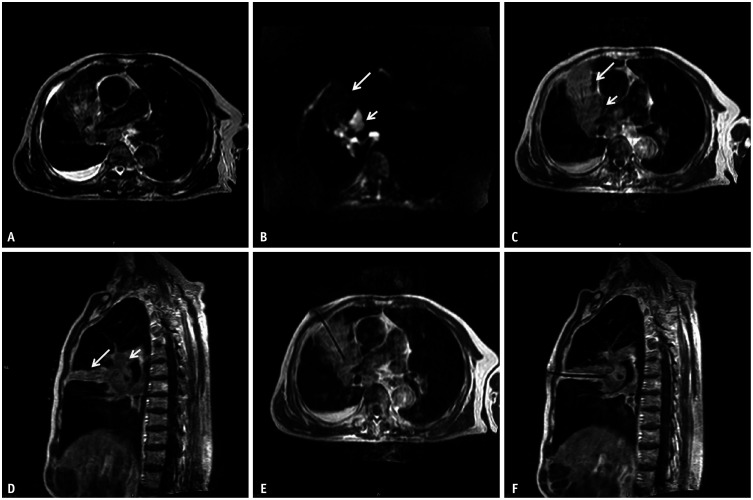 Feasibility of Multiparameter MRI-Guided Percutaneous Biopsy for Central Lung Lesions With Atelectasis.