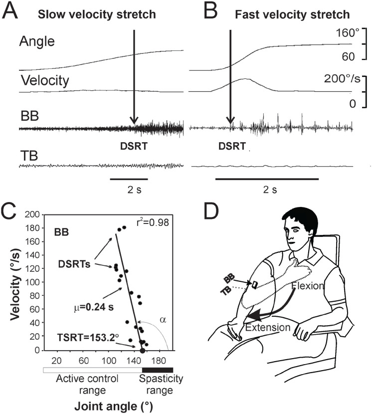 Clinical Relevance of the Tonic Stretch Reflex Threshold and μ as Measures of Upper Limb Spasticity and Motor Impairment After Stroke.