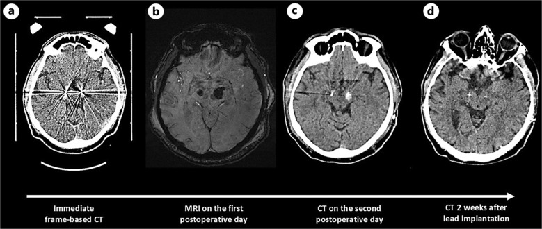 Delayed Intracerebral Hemorrhage after Deep Brain Stimulation for Parkinson's Disease.