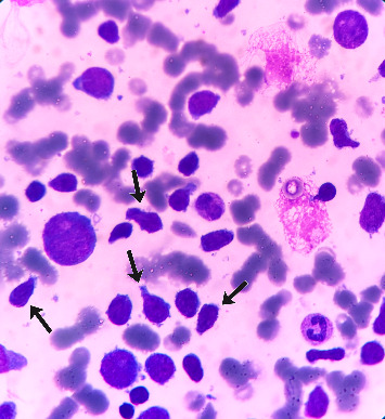 Unusual Presentation of Childhood Leukemia With Vaginal Bleeding: A Case Report.