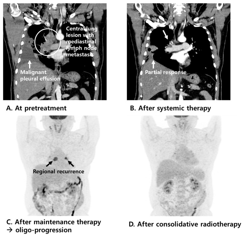 Preliminary Results of Clinical Experience with Consolidative High-Dose Thoracic Radiotherapy for Patients with Extensive-Stage Small Cell Lung Cancer.