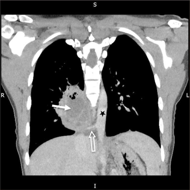 A Case of an Uncommon Cause of Pulmonary Abscess: Intralobar Bronchopulmonary Sequestration.