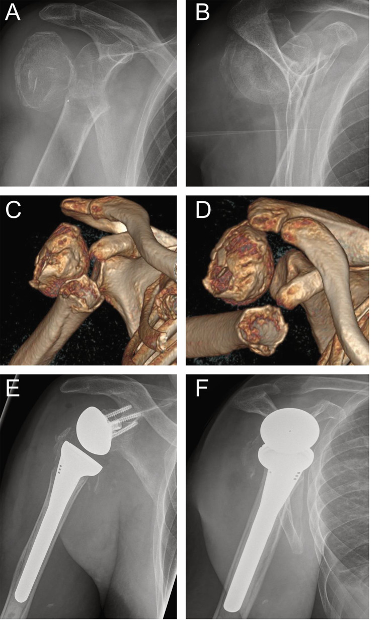 Prosthetic treatment of proximal humerus fractures in the elderly.