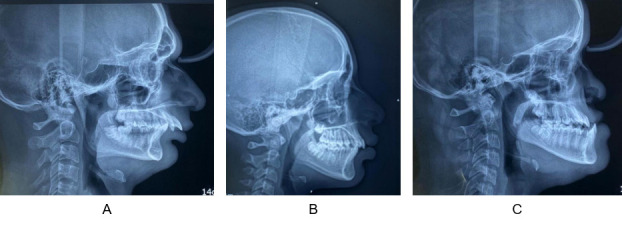 A study of correlation of cheiloscopy, fingerprint patterns and palatoscopy in skeletal malocclusions.