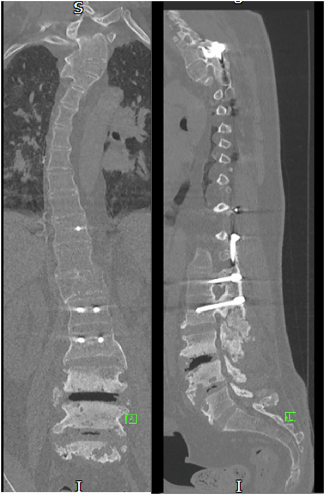 Charcot spinal arthropathy: a case series.