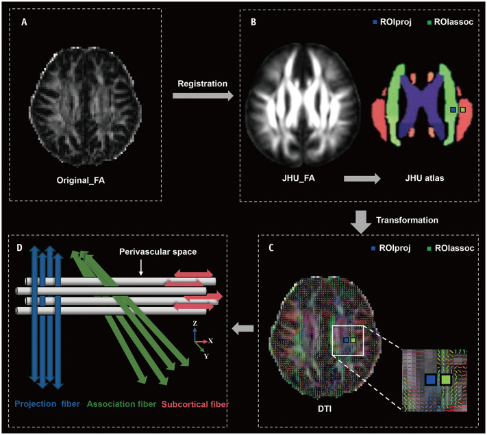 Multi-Parameter MRI for Evaluating Glymphatic Impairment and White-Matter Abnormalities and Discriminating Refractory Epilepsy in Children.