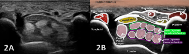 Diagnostic Musculoskeletal Ultrasound in the Evaluation of the Median Nerve.