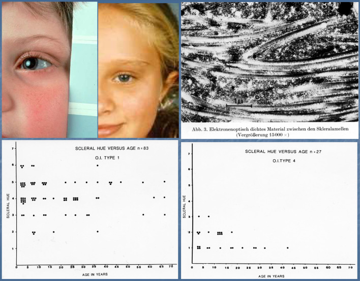 Six at Sixty. Commentary on osteogenesis imperfecta 1975-2025.