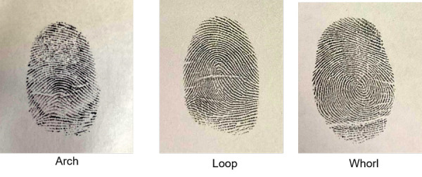 A study of correlation of cheiloscopy, fingerprint patterns and palatoscopy in skeletal malocclusions.