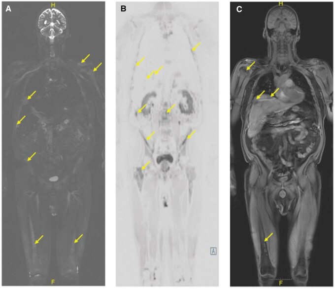 Whole-body MRI for a patient with progressive multiple myeloma.