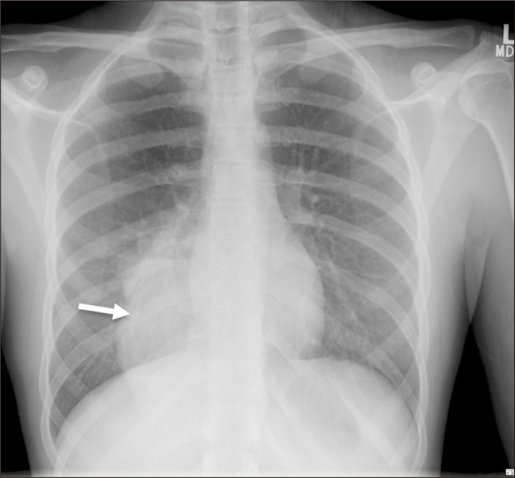 A Case of an Uncommon Cause of Pulmonary Abscess: Intralobar Bronchopulmonary Sequestration.